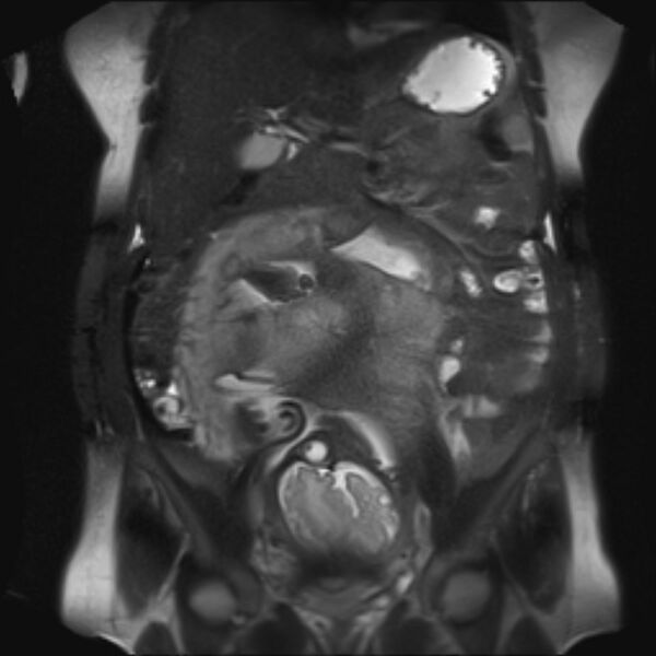 File:Bilobed placenta accreta (Radiopaedia 69648-79591 Coronal T2 fat sat 21).jpg