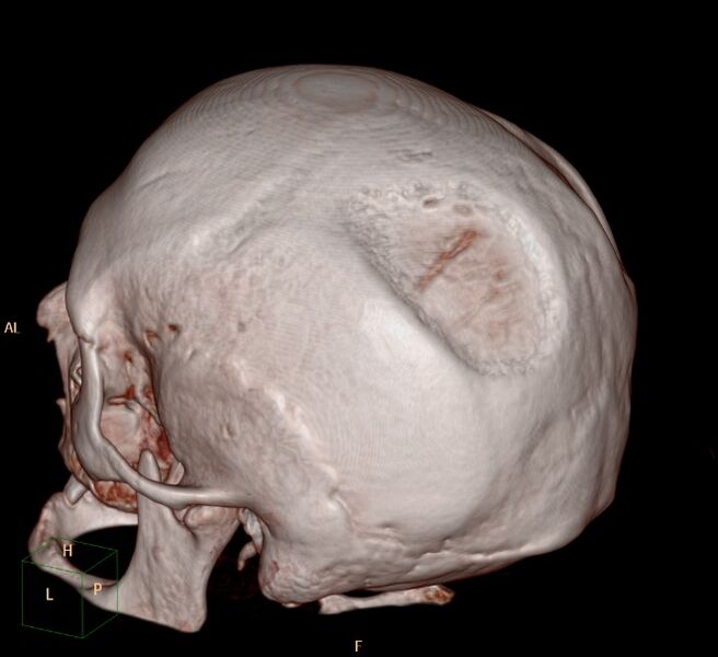 File:Biparietal osteodystrophy (Radiopaedia 46109-50463 3D 3D VR 8).jpg