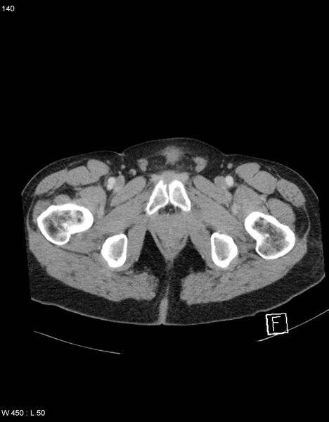File:Boerhaave syndrome with tension pneumothorax (Radiopaedia 56794-63603 A 70).jpg