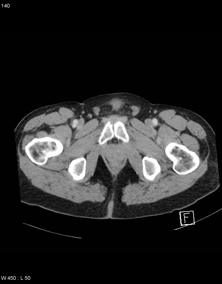 Boerhaave syndrome with tension pneumothorax (Radiopaedia 56794-63603 A 70).jpg
