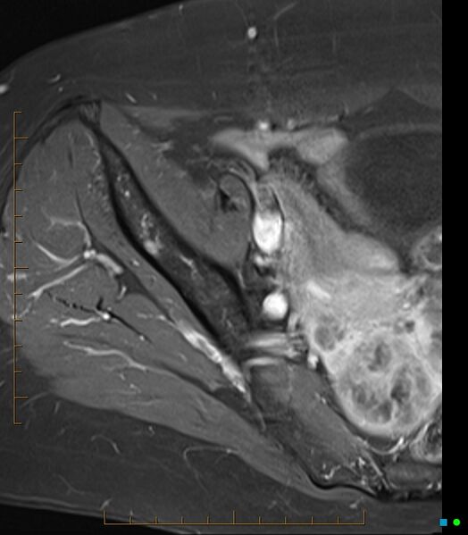 File:Bone metastasis - breast cancer (Radiopaedia 16667-16374 Axial T1 C+ fat sat 21).jpg