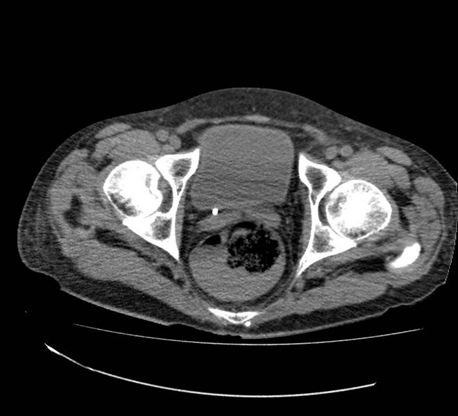 File:Bowel lymphoma complicated by bleeding after therapy (Radiopaedia 55601-62110 Axial non-contrast 77).jpg
