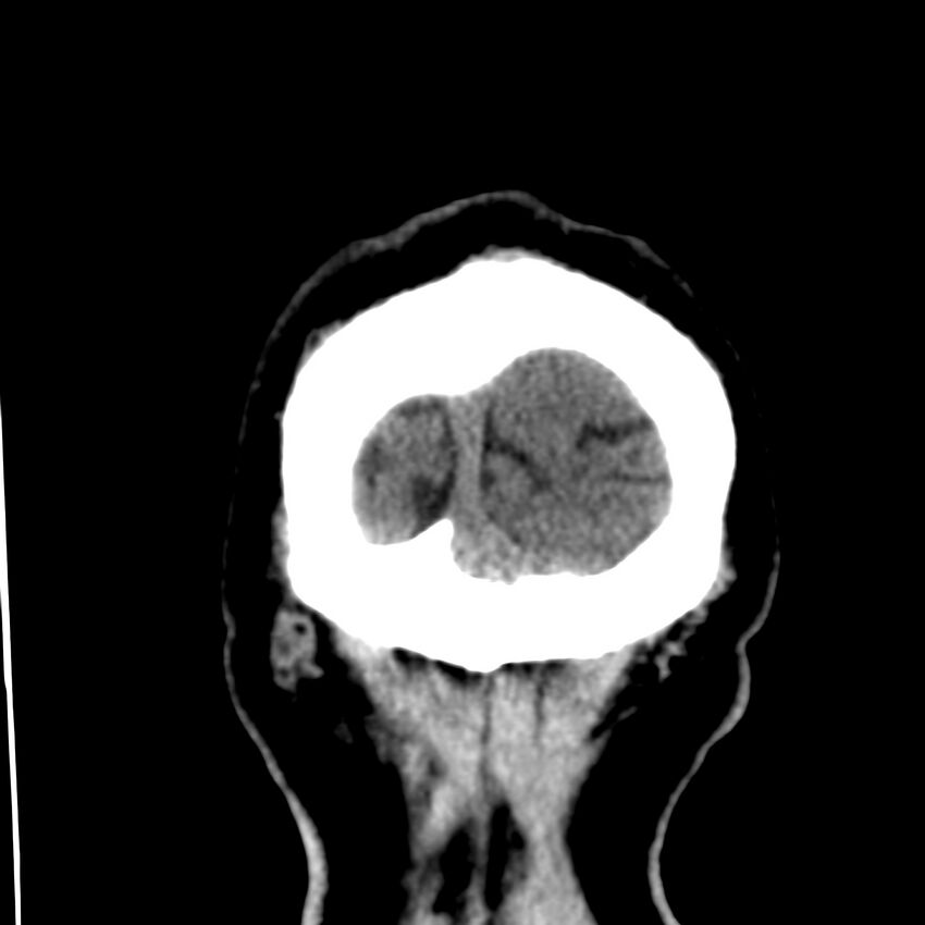 Brain Pantopaque remnants (Radiopaedia 78403-91048 Coronal non-contrast 68).jpg