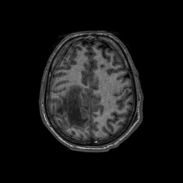 File:Brain abscess complicated by intraventricular rupture and ventriculitis (Radiopaedia 82434-96577 Axial T1 53).jpg