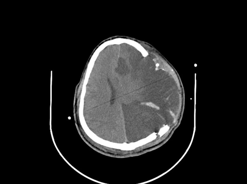 File:Brain injury by firearm projectile (Radiopaedia 82068-96087 B 128).jpg
