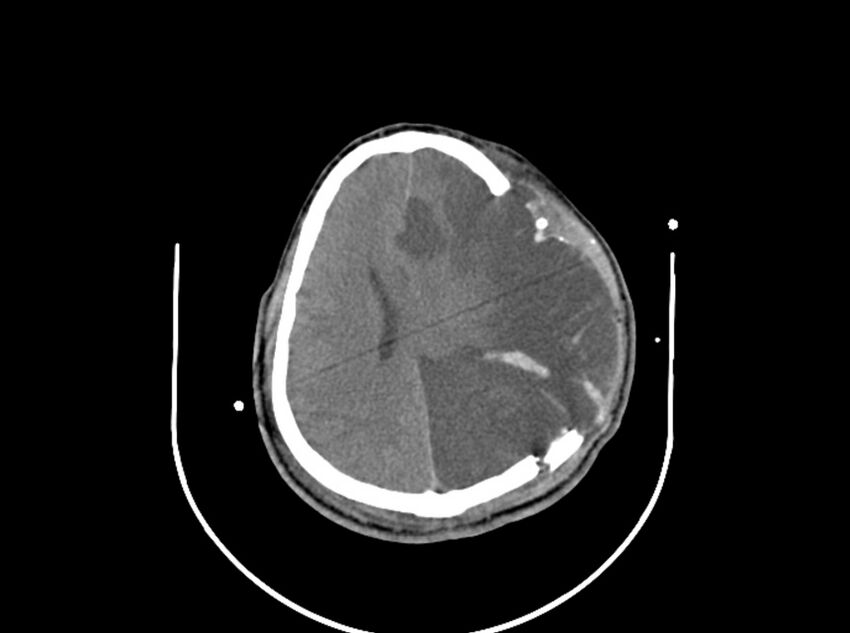 Brain injury by firearm projectile (Radiopaedia 82068-96087 B 128).jpg