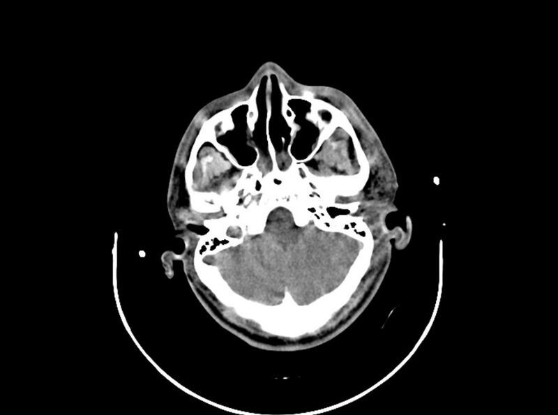 File:Brain injury by firearm projectile (Radiopaedia 82068-96087 B 58).jpg