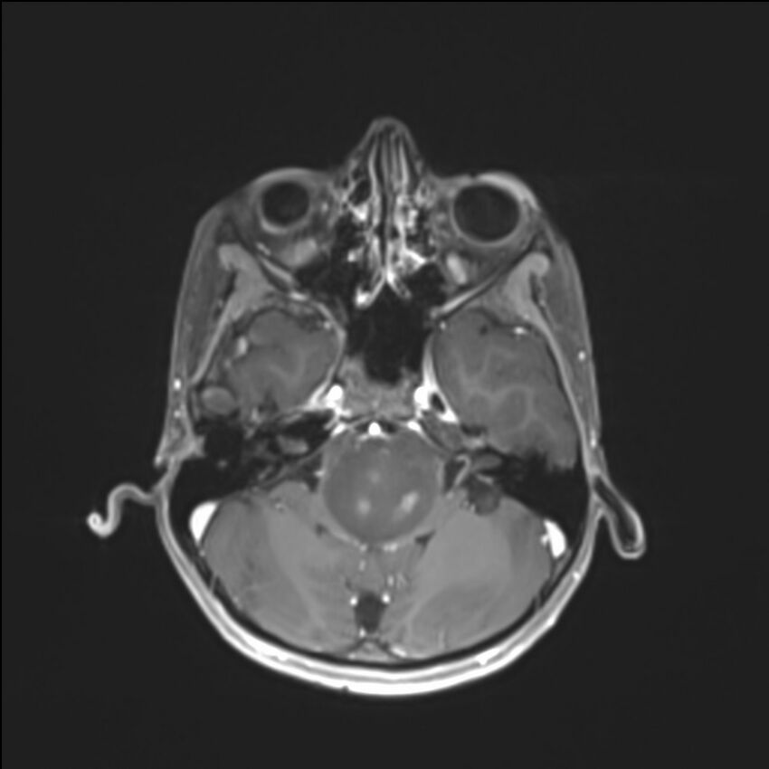Brainstem glioma (Radiopaedia 70548-80674 Axial T1 C+ 42).jpg