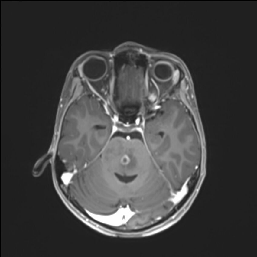 Brainstem glioma (Radiopaedia 70548-80674 Axial T1 C+ 57).jpg