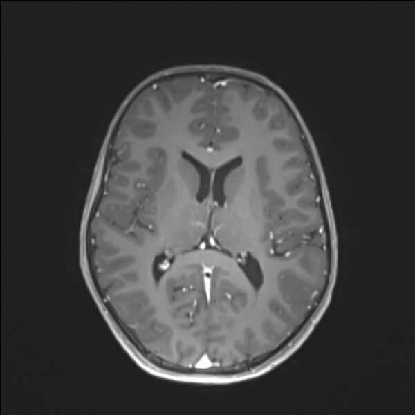 File:Brainstem glioma (Radiopaedia 70548-80674 Axial T1 C+ 91).jpg