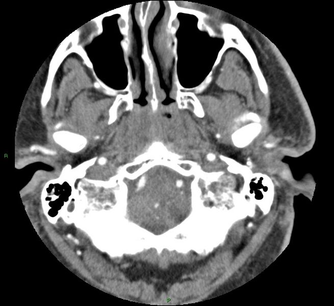 File:Brainstem hemorrhage (Radiopaedia 58794-66028 D 26).jpg