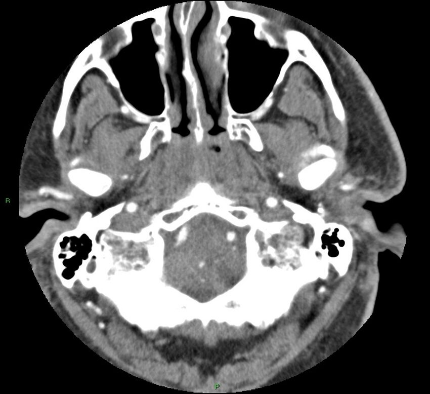 Brainstem hemorrhage (Radiopaedia 58794-66028 D 26).jpg