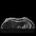 Breast implants - MRI (Radiopaedia 26864-27035 Axial T2 2).jpg