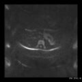 Broad ligament fibroid (Radiopaedia 49135-54241 Axial DWI 1).jpg