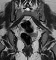 Broad ligament leiomyoma (Radiopaedia 81634-95516 Coronal T2 18).jpg