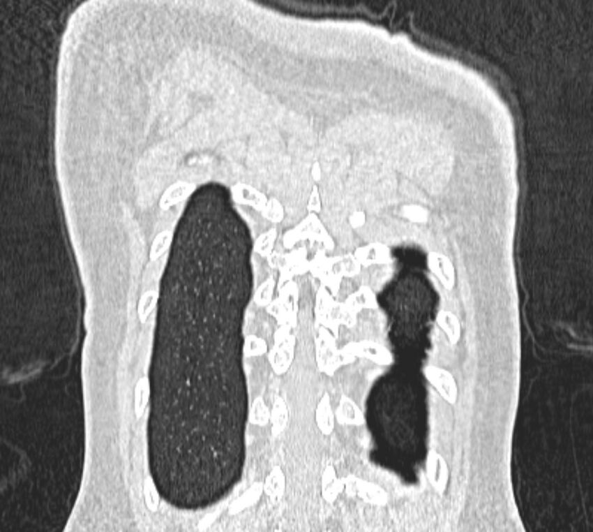 Bronchial atresia (Radiopaedia 50007-55297 Coronal lung window 110).jpg