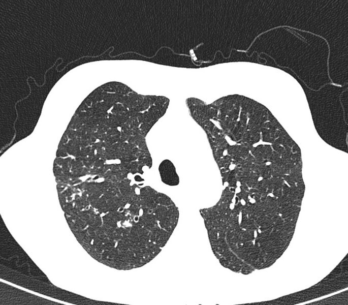 File:Bronchiolitis (Radiopaedia 24616-24887 Axial lung window 14).jpg