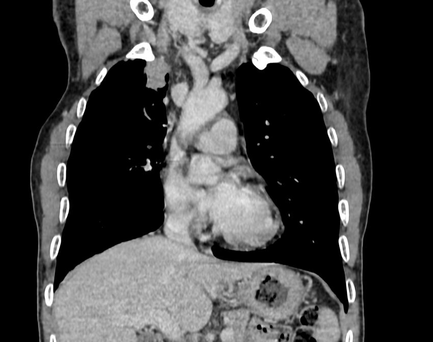 Bronchogenic carcinoma with superior vena cava syndrome (Radiopaedia 36497-38054 Coronal C+ delayed 20).jpg
