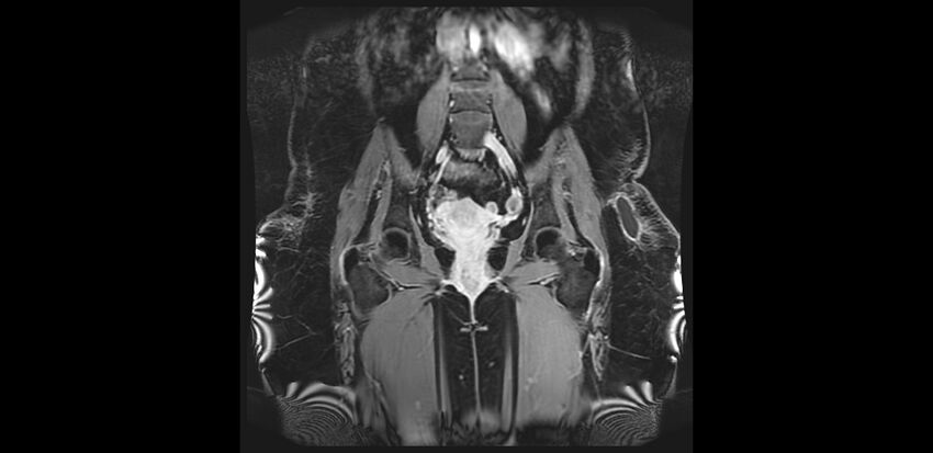 Buttock filler complications (Radiopaedia 63497-72115 Coronal T1 C+ 22).jpg