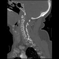 C1 anterior arch (plough) fracture - type 1 (Radiopaedia 76181-87720 Sagittal bone window 67).jpg