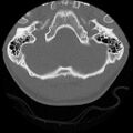 C5 facet fracture (Radiopaedia 58374-65499 Axial bone window 2).jpg
