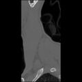 C5 facet fracture (Radiopaedia 58374-65499 Sagittal bone window 8).jpg