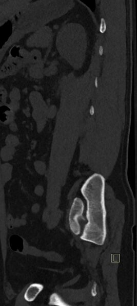 File:Calcaneal fractures with associated L2 burst fracture (Radiopaedia 71671-82493 Sagittal bone window 6).jpg