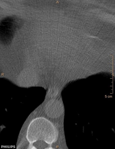 File:Calcified cardiac fibroma (Radiopaedia 39267-41519 Axial bone window 18).jpg