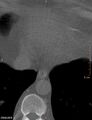Calcified cardiac fibroma (Radiopaedia 39267-41519 Axial bone window 18).jpg