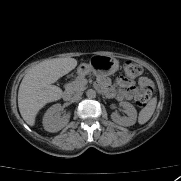 File:Calcified hepatic hydatid cyst (Radiopaedia 26872-27046 Axial non-contrast 34).jpg