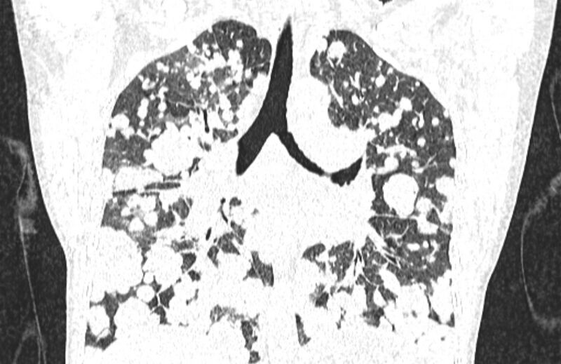 File:Cannonball metastases from breast cancer (Radiopaedia 91024-108569 Coronal lung window 83).jpg
