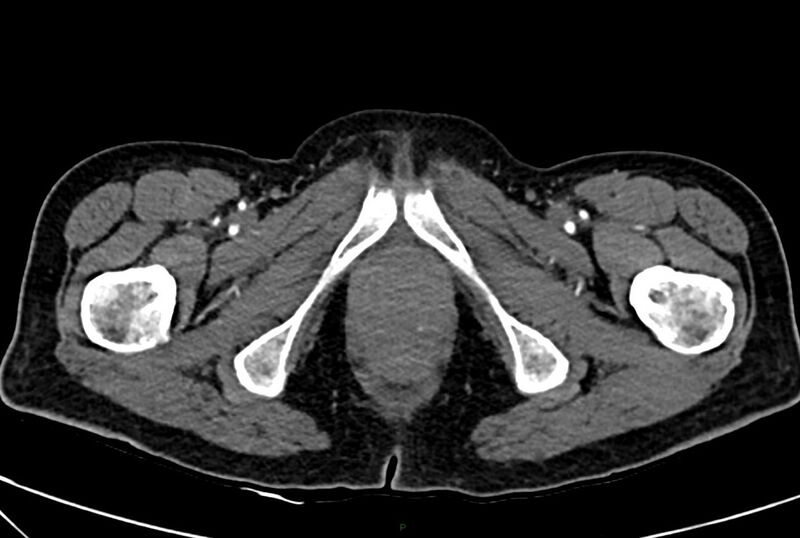 File:Carcinoid mesenteric tumor complicated by chylous ascites (Radiopaedia 76312-88926 A 83).jpg