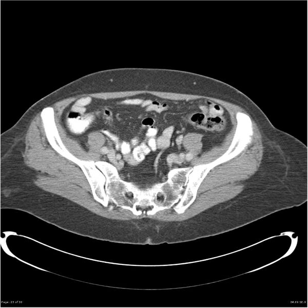 File:Carcinoid tumor of the ileum with metastasis to orbit (Radiopaedia 28165-28425 A 23).jpg