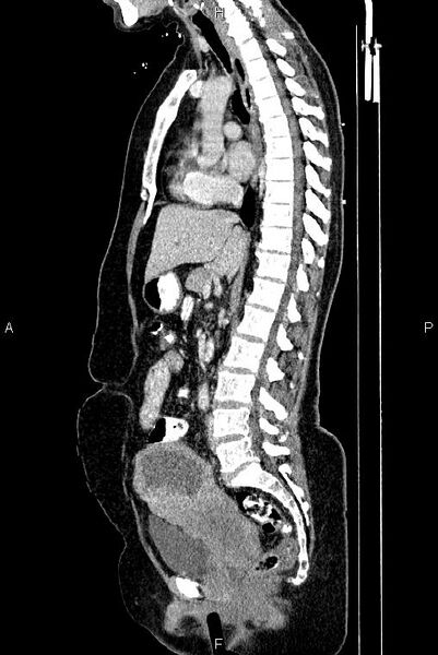 File:Carcinoma of uterine cervix (Radiopaedia 85861-101700 D 41).jpg