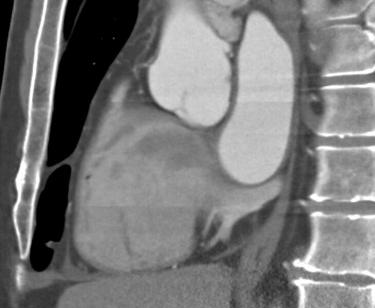 File:Cardiac hemangioma (Radiopaedia 16971-16679 C 13).JPG