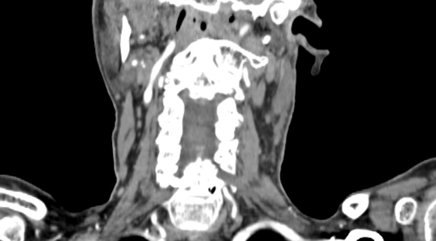 Carotid artery pseudoaneurysm (Radiopaedia 84030-99259 D 62).jpg