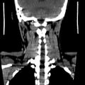 Carotid body tumor (Radiopaedia 27890-28124 B 1).jpg