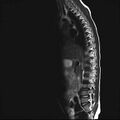 Caudal regression syndrome (Radiopaedia 61990-70072 Sagittal T2 2).jpg