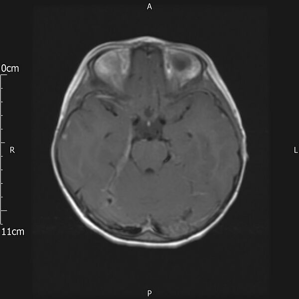 File:Cavernous sinus thrombosis (Radiopaedia 79414-92512 Axial T1 C+ 11).jpg