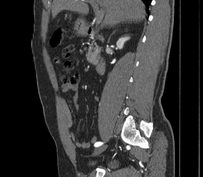 File:Celiac artery dissection (Radiopaedia 52194-58080 B 1).jpg