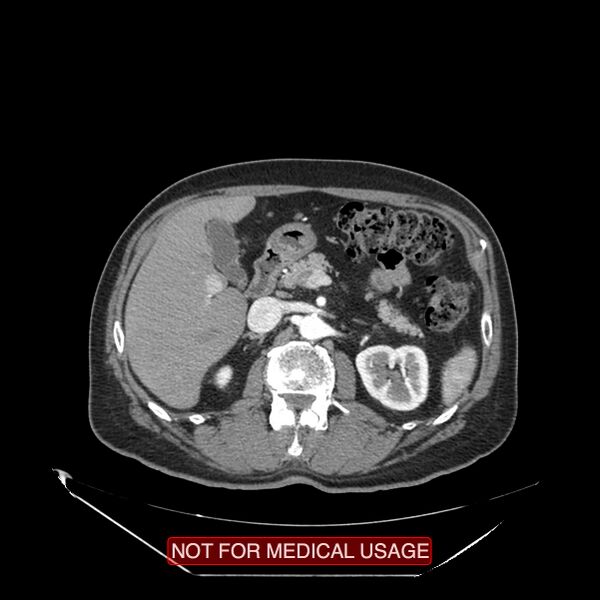 File:Celiac trunk variant anatomy - gastrohepatic trunk and splenic artery (Radiopaedia 38815-40995 A 37).jpg