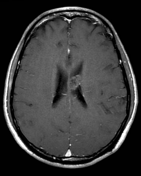 File:Central neurocytoma (Radiopaedia 2590-6285 Axial T1 C+ 1).jpg