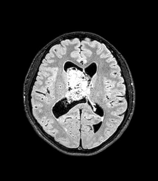 File:Central neurocytoma (Radiopaedia 79320-92380 Axial FLAIR 143).jpg