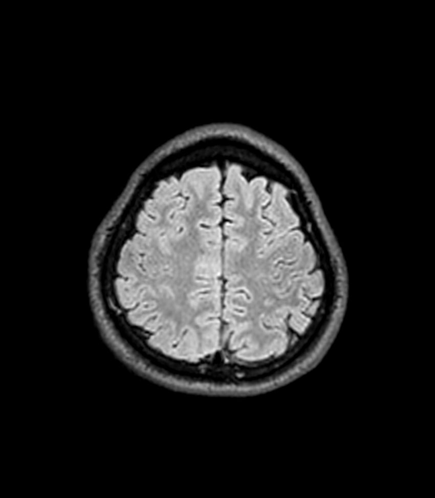Central neurocytoma (Radiopaedia 79320-92380 Axial FLAIR 71).jpg