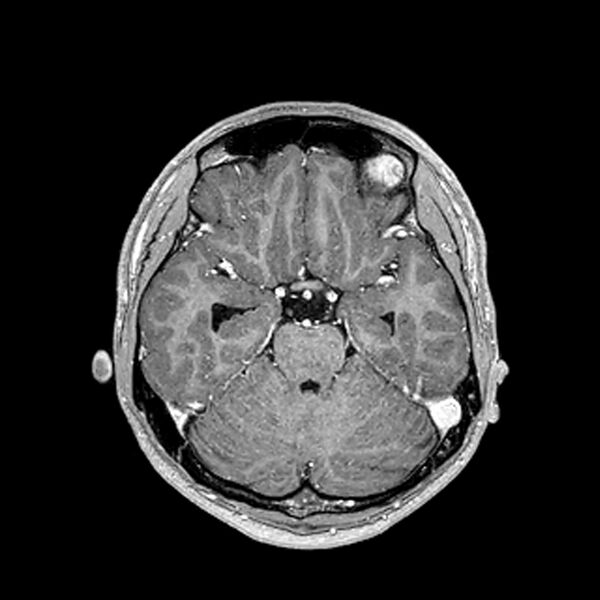 File:Central neurocytoma (Radiopaedia 79320-92380 Axial T1 C+ 95).jpg