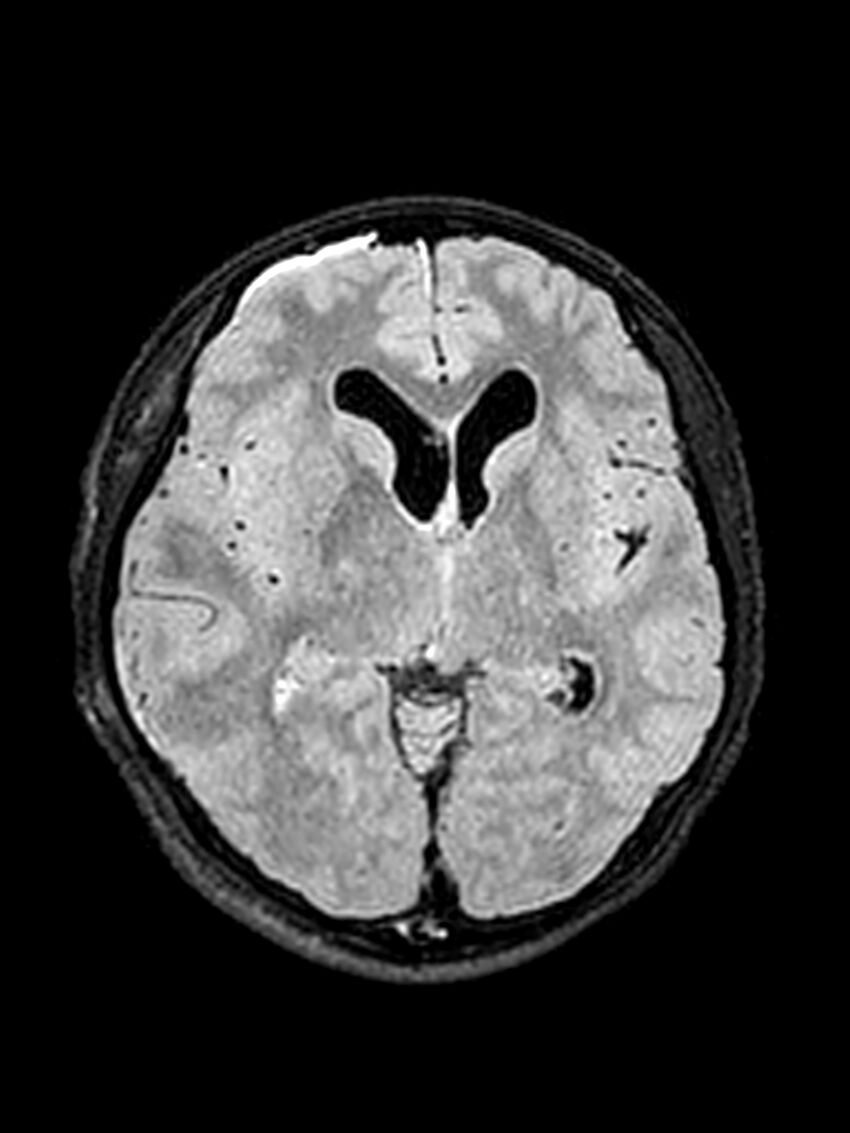 Central neurocytoma (Radiopaedia 79320-92381 Axial FLAIR 93).jpg