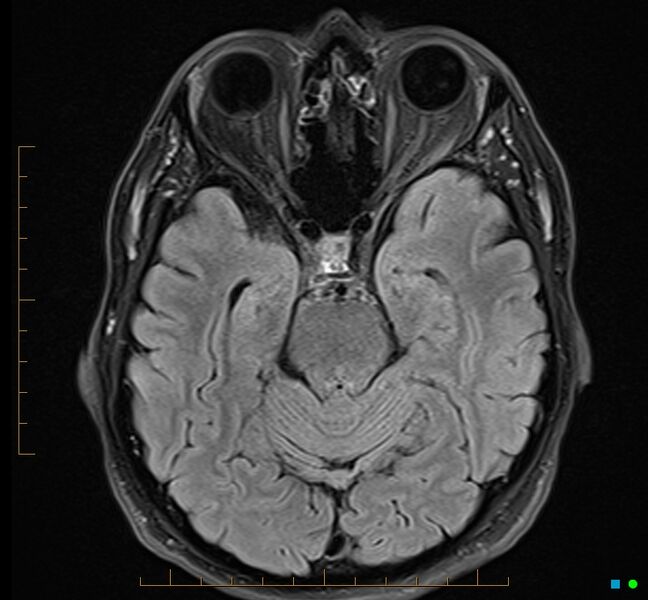 File:Cerebellar gangliocytoma (Radiopaedia 65377-74422 Axial FLAIR 13).jpg