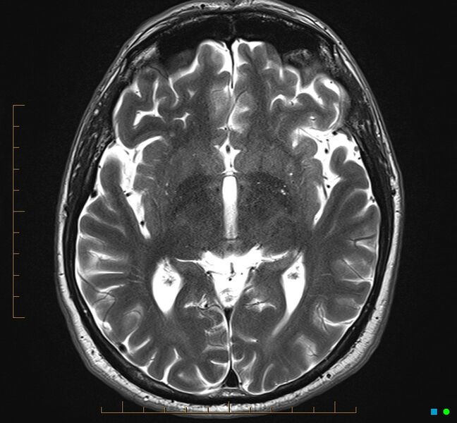 File:Cerebellar gangliocytoma (Radiopaedia 65377-74422 Axial T2 18).jpg