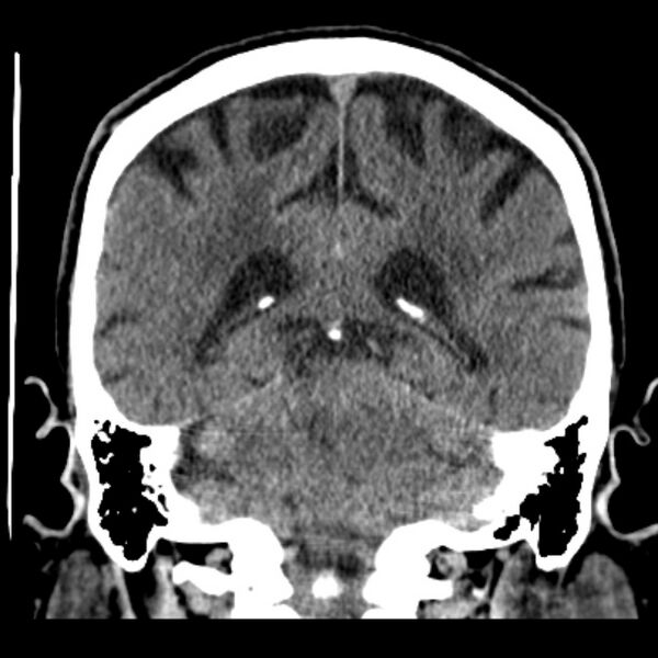 File:Cerebellar hemorrhage (Radiopaedia 27193-27359 Coronal non-contrast 38).jpg