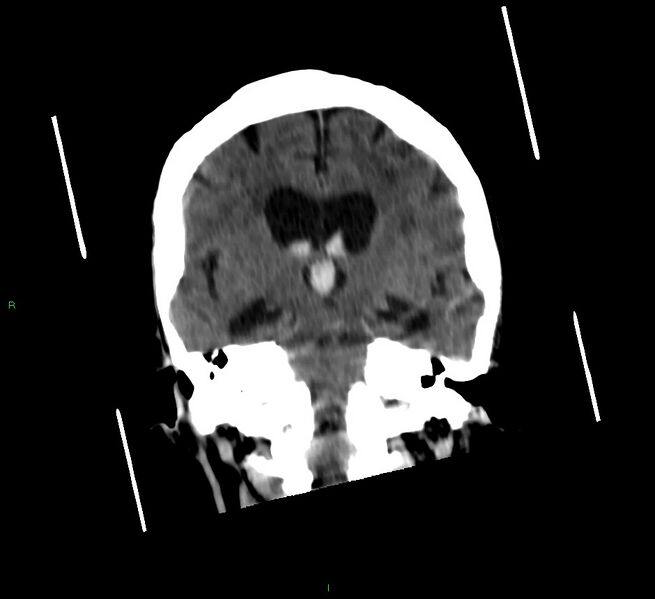 File:Cerebellar hemorrhage (Radiopaedia 58792-66026 Coronal non-contrast 34).jpg